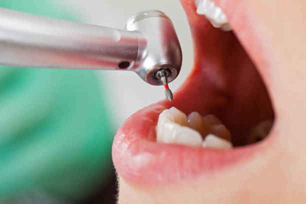 Best Lost Filling or Crown Replacement in Winchester, OH